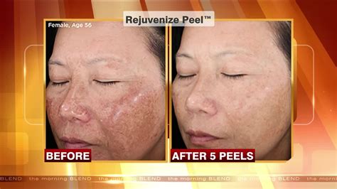 The Benefits Of A Chemical Peel Youtube