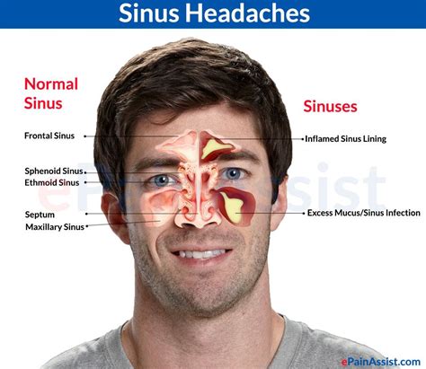 Chris McNeil Chiropractor Sinus Headache Releif Sinus Headache