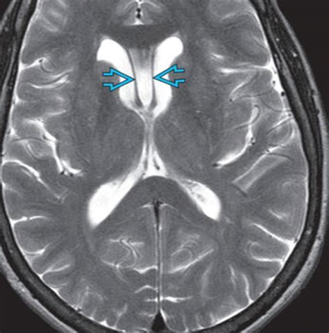 Cavum Septi Pellucidi Csp Brain Imaging