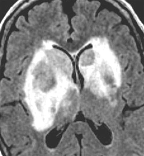 Ct And Mri Findings Of Intracranial Lymphoma Ajr