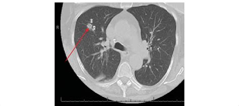 A Ct Chest Showed Right Lower Lobe 12 Cm Pulmonary Nodule Download