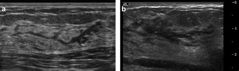 Ultrasound Image Classification Of Ductal Carcinoma In Situ Dcis Of