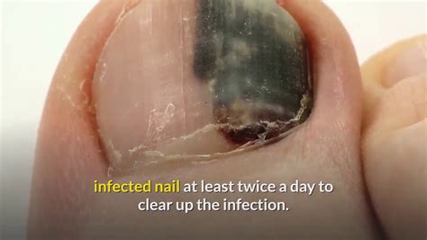 Nail Fungus Treatment With Home Remedies Youtube