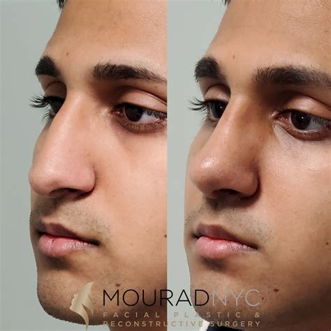 Male Closed Rhinoplasty Before and After - Head and Neck Surgeon