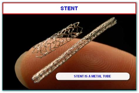 Facts About Stent Angioplasty Or Ptca