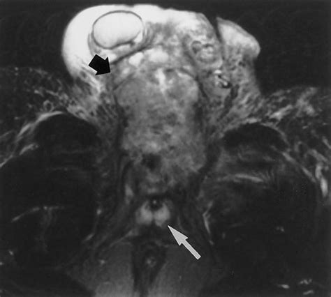 Mr Imaging Of The Penis Radiographics