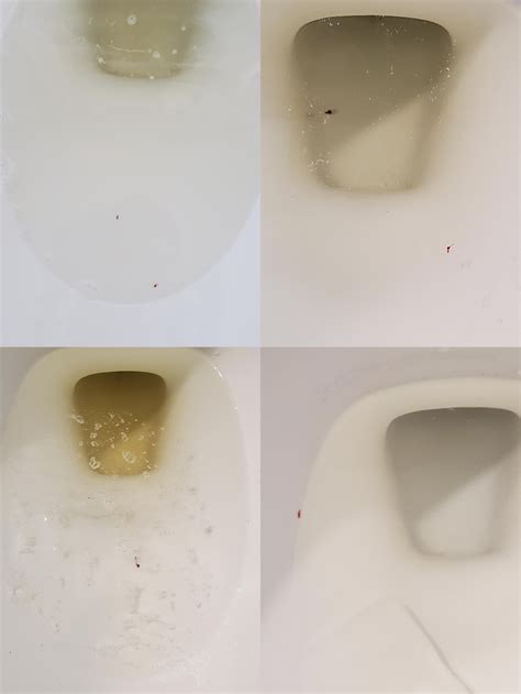 Very Tiny Blood Specks In Urine But Cystoscopy Clear Mild Prostatitis