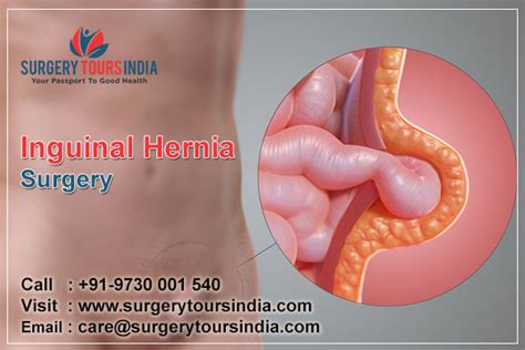 Inguinal Hernia Surgery Causes Treatments And Risks Surgery Tours