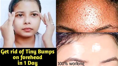 How To Get Rid Of Small Bumps On Forehead And Bumpy Skin Quicklyhindisk Be Beautiful Youtube