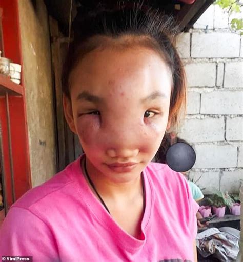 Teenage Mother Left With Huge Facial Swelling After Squeezing A Spot On