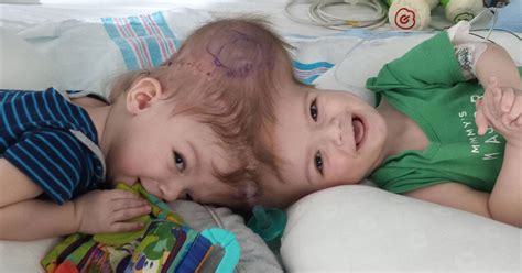 My Heart Aches Mothers Joy As Twins Conjoined At The Head Reunited