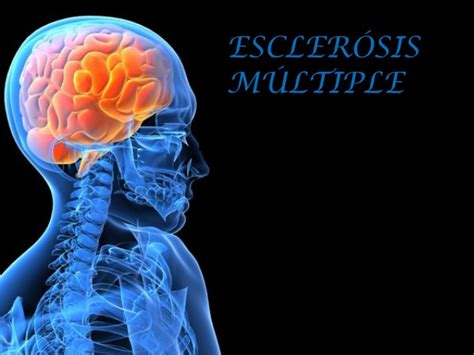 Se ha registrado en el 62,2 por ciento de los pacientes españoles y es la forma más frecuente en el diagnóstico. Esclerosis multiple