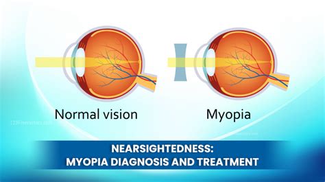 Nearsightedness Myopia Diagnosis And Treatment Dlei
