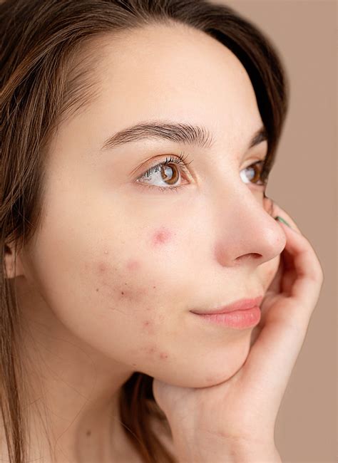 Understanding And Managing Nodular Acne A Comprehensive Guide Kins