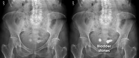 Abdominal X Ray Gallery Calcification Bladder Stones