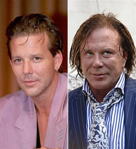 Mickey Rourke Cirurgia Plastica Botox Atores