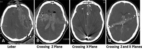 Neurosurgical Treatment For Gunshot Wound Head Trauma