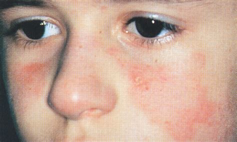 Malar Rash In A Child—quiz Case Dermatology Jama Dermatology