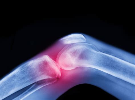 Overview Of Knee Joint Infection Treatment