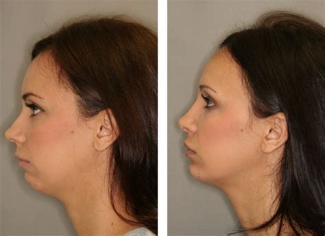 Pin By Lynette Foster On Get Rid Of A Double Chin With Face Exercises