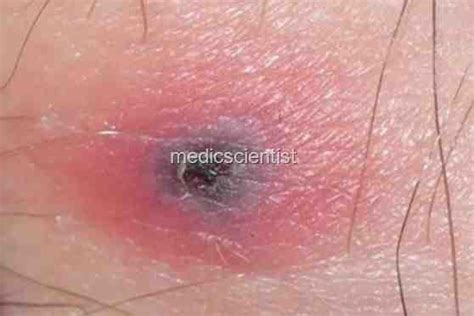 Rickettsial Diseases Rocky Mountain African Tick Bite Rickettsial Pox
