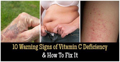 10 Warning Signs Of Vitamin C Deficiency And How To Fix It Vitamin C Benefits Vitamin C Vitamins