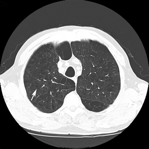 Challenges In Pulmonary Fibrosis · 3 Cystic Lung Disease Thorax