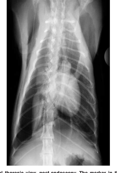 Figure 1 From Pneumomediastinum Pneumothorax And