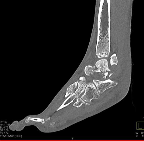 Multiple Fractures Including Tibia And Talus Trauma Case Studies