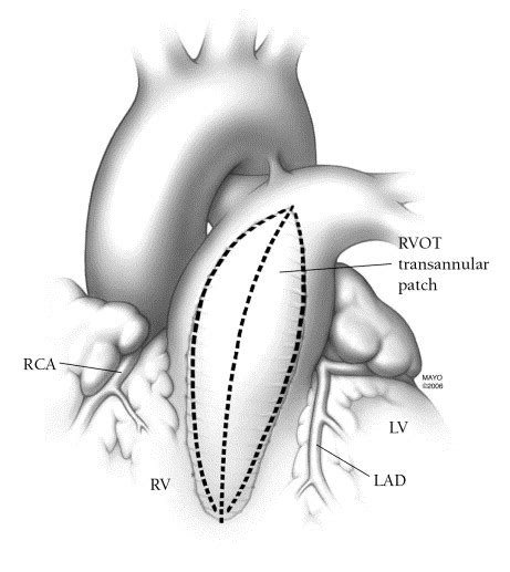 Technique Of Mechanical Pulmonary Valve Replacement Operative