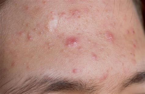 What Is Papulopustular Rosacea With Pictures
