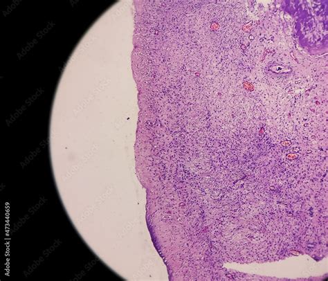 Inflammatory Breast Lump Chronic Nonspecific Mastitis With Fibrocystic