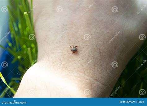 Infected Dangerous Biting Tick On Human Skin Stock Image Image Of