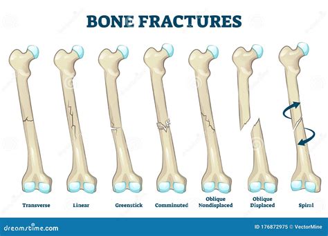 Bone Fractures Vector Illustration Labeled Various Broken Leg Or Arm