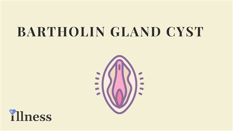 Bartholin Gland Cyst Overview Causes Symptoms Treatment