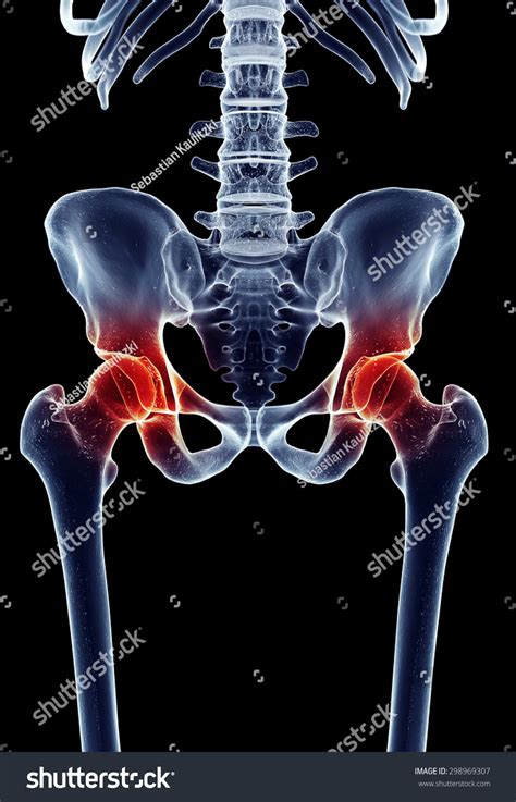 Medically Accurate Illustration Painful Hip 298969307 Shutterstock