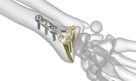 How Orthopaedic Implants Give The Sure Benefits Samay Surgical