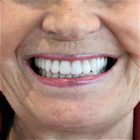 Simply Beautiful Smile — Pearl Denture And Implant Centre