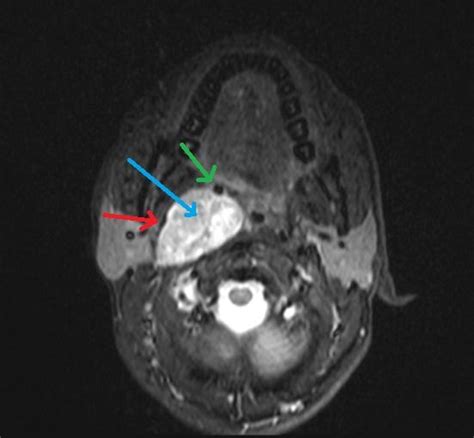 Ct And Mri Findings In A Case Of Carotid Body Paraganglioma Eurorad