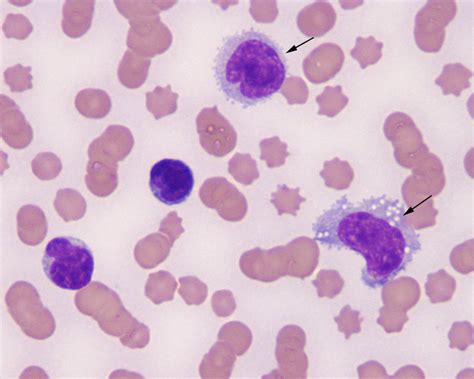 Lymphocyte Archives Eclinpath