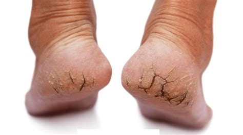 Dry Skin On Feet Causes And How To Get Rid Of It Naildesigncode