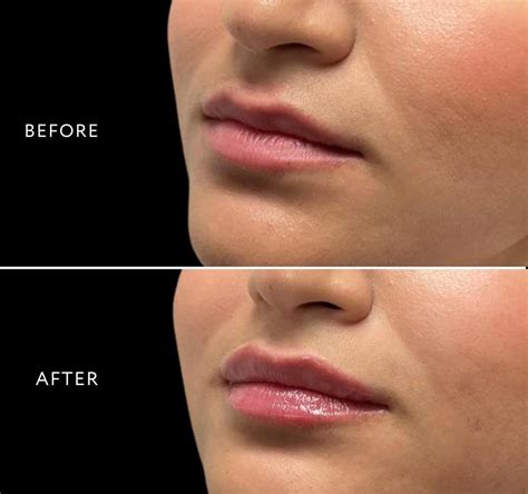 Restylane Filler Injections Miami Plastic Surgery