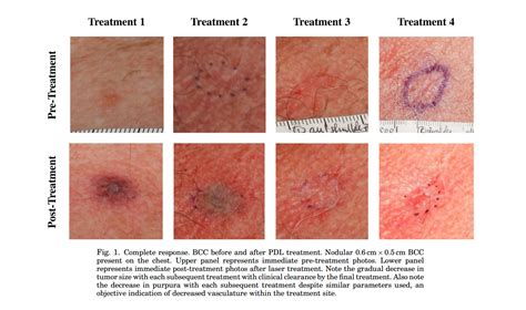 Superficial Basal Cell Carcinoma