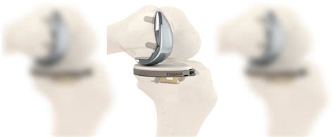 510k Clearance For 1st Cementless Partial Knee System In Us