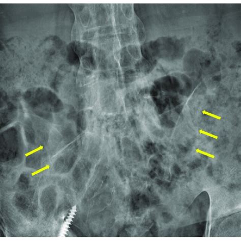 A Plain Radiograph Of The Pelvis Demonstrated Sclerosis Partial