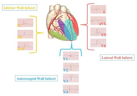Boot Ecg Understanding Heart Anatomy As It Relates To The 12 Lead Ekg