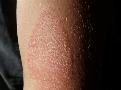 Pacientes De Dermatitis Atópica Perciben Un Aumento De Reacciones En La