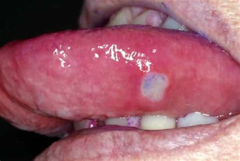 White Spots On Tongue Tip Side Under Back Dots Patches Single