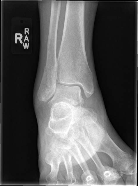 Picture Of Spiral Fracture Of Fibula Spiral Fracture Healing Time