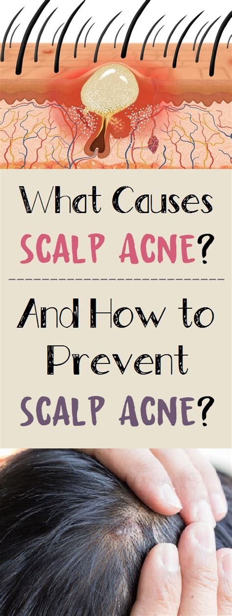 What Causes Scalp Acne And How To Prevent It How To Beauty